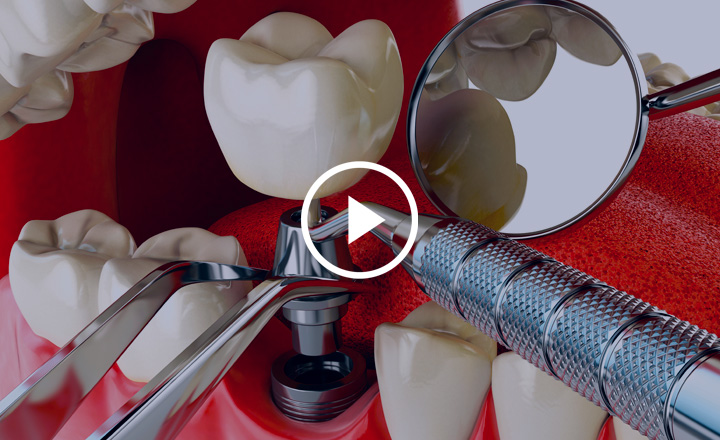  Implantes Dentários